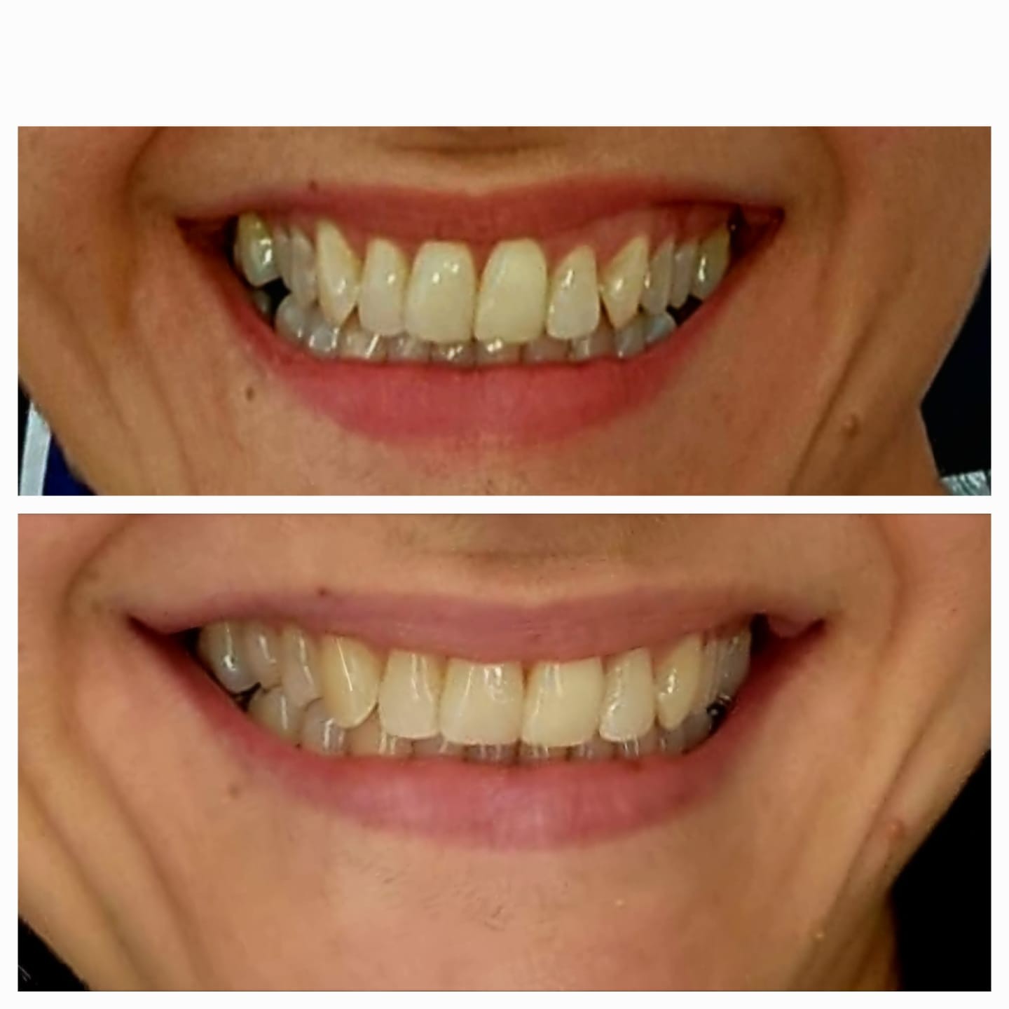Antes e depois de estética dental - caso 1