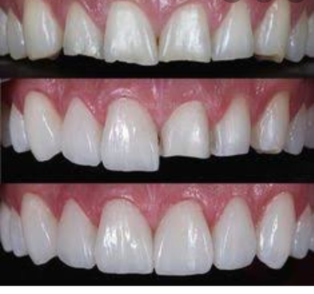 Antes e depois de estética dental - caso 2