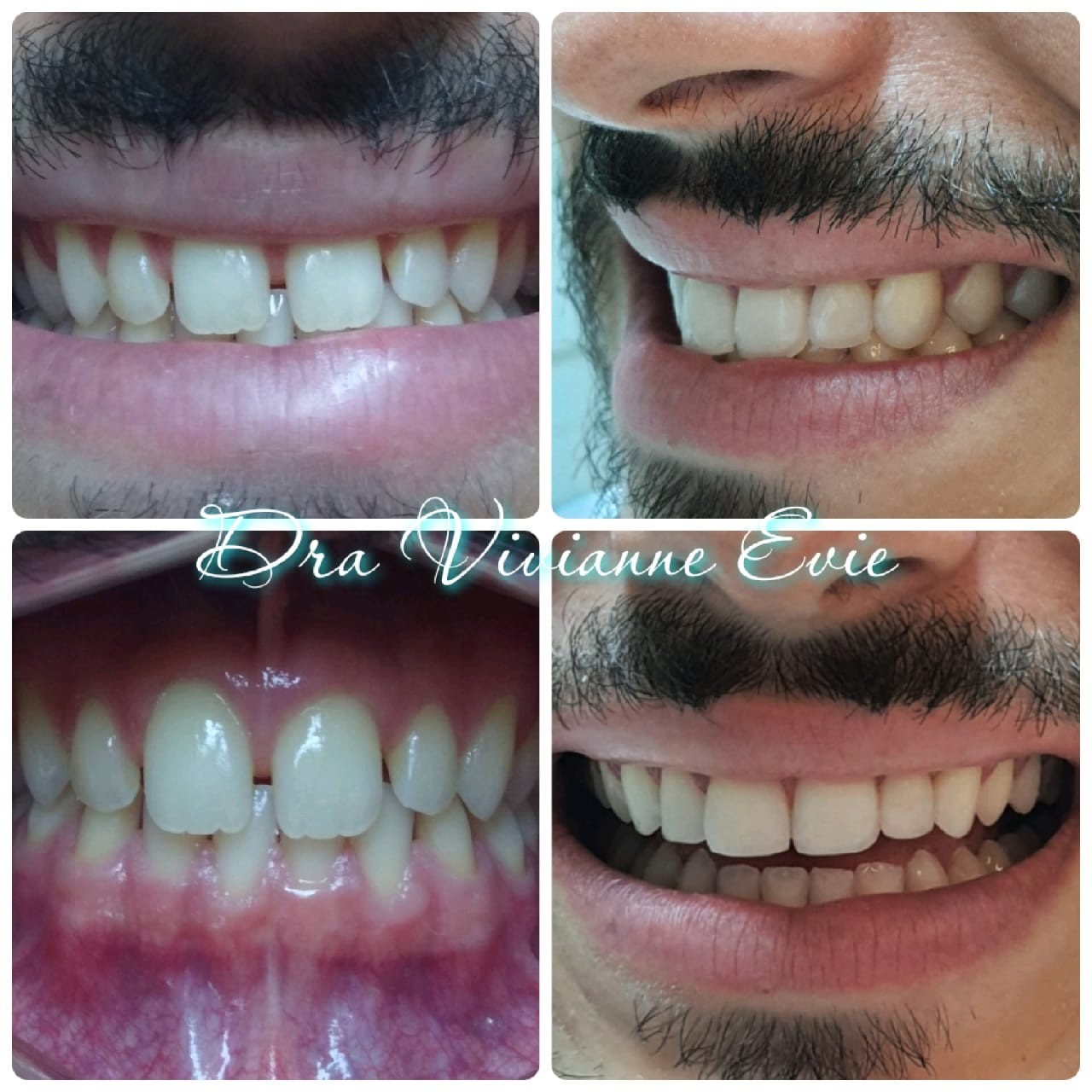 Antes e depois de clareamento dental